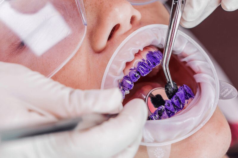 Identificação do biofilme em uma paciente realizando a limpeza dentária com o método GBT.